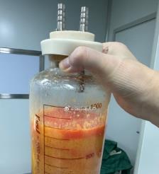 临沂水动力吸脂手术要做多久？